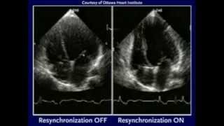 Demonstration of the efficacy of CRT Cardiac Resynchronization with Echocardiogram [upl. by Airalednac683]