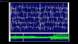 Kimura amp Kohara F20 Myotonic discharges mixed with spontaneous single muscle fiber discharges [upl. by Eeleak16]