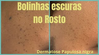 Como acabar com a Dermatose Papulosa Nigra Bolinhas escuras na pele nunca mais  Jato de Plasma [upl. by Narcho]