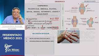 Reumatología  6 Artritis Reumatoide AR [upl. by Mecke]