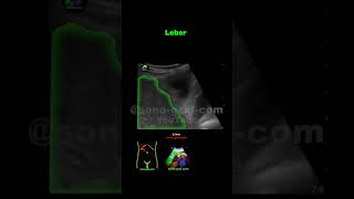 Sonographie  Cholezystitis [upl. by Enalda628]