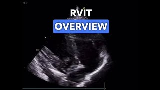 Right Ventricular Inflow Tract RVIT View  Echocardiography Education [upl. by Aivil]