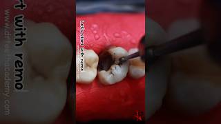 How is Root Canal Treatment RCT done dentist rct [upl. by Zeuqcaj]