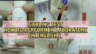 Sickling testHow to perform in labStep by step explanationSickle solubility test In English [upl. by Llekram910]