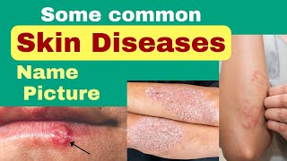 Skin diseases name and picture  skin diseases picture with name  skin problem [upl. by Dickson]