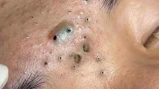 Big Cystic Acne Blackheads Extraction Blackheads amp Milia Whiteheads Removal Pimple Popping  2632 [upl. by Ecirtam]