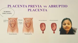 PLACENTA PREVIA VS ABRUPTIO PLACENTA FOR NCLEX EXAM AND NURSES USRN USNURSE [upl. by Lonergan583]