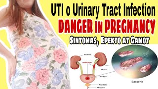 UTI EPEKTO SA BUNTIS  Sintomas at Gamutan  Urinary Tract Infection UTI Pregnancy [upl. by Map110]