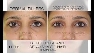 Dermal Fillers Under Eye Hollows amp Pigmentation Tear Trough Treatment by Dr Akshay G Nair [upl. by Etireuqram237]