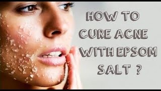 HOW TO TREAT ACNE WITH EPSOM SALT 10 BEST RECIPES [upl. by Pinkham]