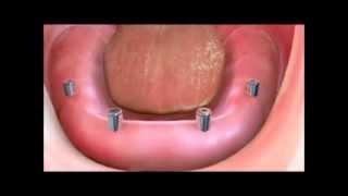 Implant Supported Dentures [upl. by Sothena333]