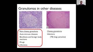 What Causes Sarcoidosis  Neurosarcoidosis Patient Day 2023 [upl. by Donnie]