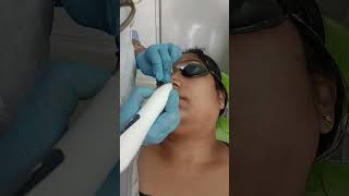 mole removal 7974419997 [upl. by Anitsirhc]