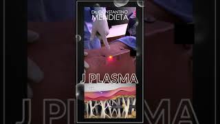 Here is How J Plasma Works  In the OR with Dr Mendieta in Miami [upl. by Ennovahs]