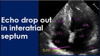 Echo drop out in interatrial septum [upl. by Alleiram]