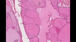 Histopathology ThyroidColloid goiter [upl. by Sinnelg228]