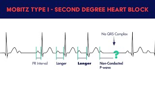 Second Degree Heart Block  Mobitz Type I [upl. by Tomlin]