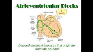 Atrioventricular Block  AV blocks made easy  AV block ECG interpretation  Types of AV Block [upl. by Oicaroh]