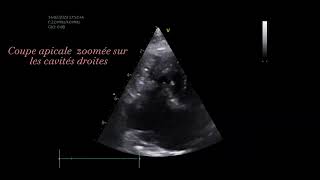 tricuspid Stenosis dog congenitalcardiology cardiology veterinary [upl. by Hedwig309]