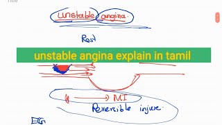 Unstable angina explain in tamil [upl. by Johansen]