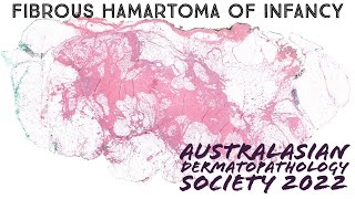 Fibrous hamartoma of infancy explained in 5 minutes pathology dermpath dermatology [upl. by Weil850]