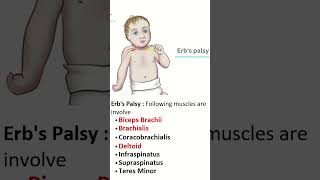 ErbDuchenne Palsy Insights into Upper Trunk Injuries of brachial plexus brachialplexusinjury [upl. by Kurzawa]