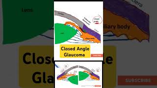 Closed Angle Glaucoma [upl. by Garold]