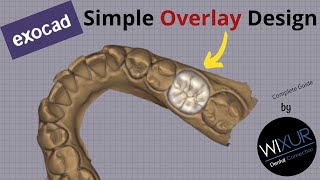Simple Overlay Design in exocad [upl. by Xilef]