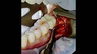 Horizontal Third Molar Extraction via Sectioning the Roots Twice dentalextractionvideo [upl. by Short]