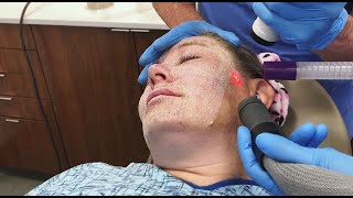 Full Face Fractional CO2 Laser Resurfacing for Wrinkles and Skin Tightening [upl. by Anawed]