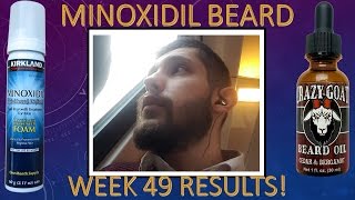 Minoxidil Beard Growth Results  Week 49  Minoxidil 5 for Beard Growth Facialfuzzfridays [upl. by Treble]