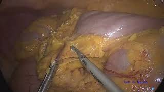 Laparoscopic left hemicolectomy [upl. by Archy631]