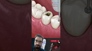 Dental Restoration ↪ Composite Bonding Teeth ↪ 3D Medical Animation [upl. by Are536]