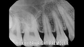 XRay lesson series 1  Full Mouth X rays [upl. by Nonarb]