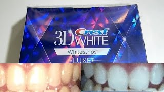 Guy with yellow teeth tests out whitening strips for 20 days Crest 3D Whitestrips [upl. by Priscella]