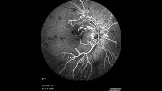 Central Retinal Vein Occlusion [upl. by Tabatha300]