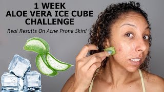 1 Week Aloe Vera ICE CUBE Challenge REAL RESULTS ACNE Skincare Update  BiancaReneeToday [upl. by Sreip]