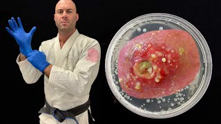 Staph Infections in Jiu Jitsu [upl. by Etiuqal]