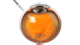 Anti VEGF Injection for macular degeneration [upl. by Tneicniv41]