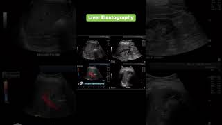 Liver Elastography [upl. by Carissa]