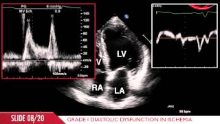 Acute Myocardial Infarction [upl. by Janicki]