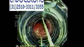 Ligadura elástica das hemorroidas com a endoscopia flexível [upl. by Neelloc807]