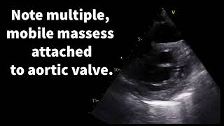 Endocarditis a case with poor prognostic features [upl. by Enylecoj]