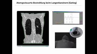 4DCT und Tumorbeweglichkeit von Bronchialkarzinomen  Strahlentherapie Prof Hilke Vorwerk [upl. by Geneva201]