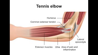 Tennis Elbow Cant Wait [upl. by Lemaj]