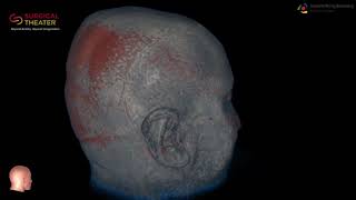 Resection of Brain Stem Cavernoma Minimally Invasive Surgery [upl. by Hanima436]