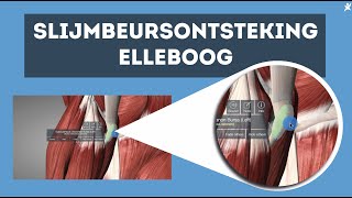 Slijmbeursontsteking elleboog Ontdek de oplossing [upl. by Niamrahc]