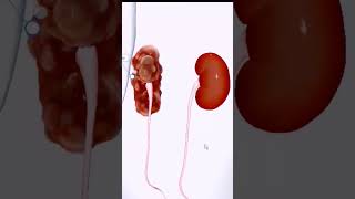 Human Anatomy Kidney  Polycystic Kidney Disease Dialysis  MBBS youtubeshorts youtube ytshorts [upl. by Olihs]