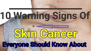 10 Warning Signs Of Skin Cancer Everyone Should Know About [upl. by Llirpa]