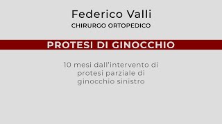 Protesi di Ginocchio 10 mesi dalloperazione di protesi parziale [upl. by Ynes]